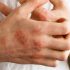DERMATITIS DE CONTACTO y COVID-19